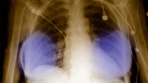 Breast implants scandal